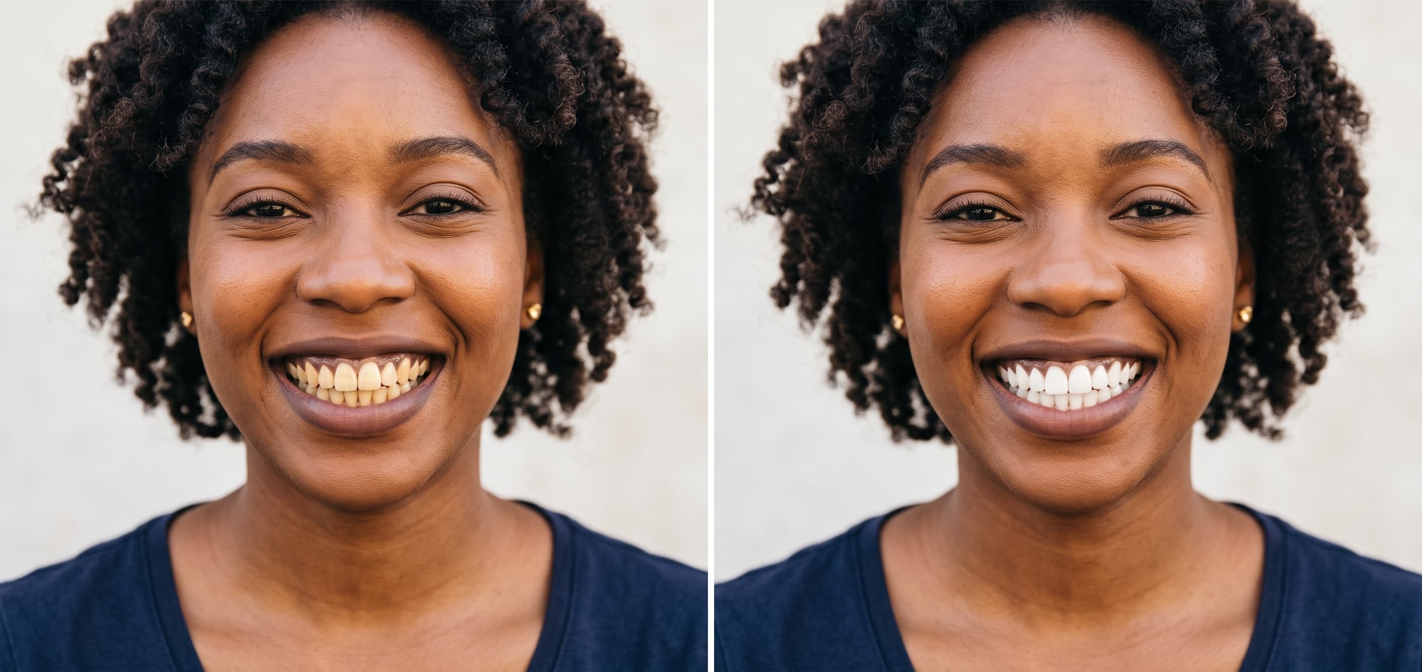 Before and after smile transformation, In-Office Laser Teeth Whitening